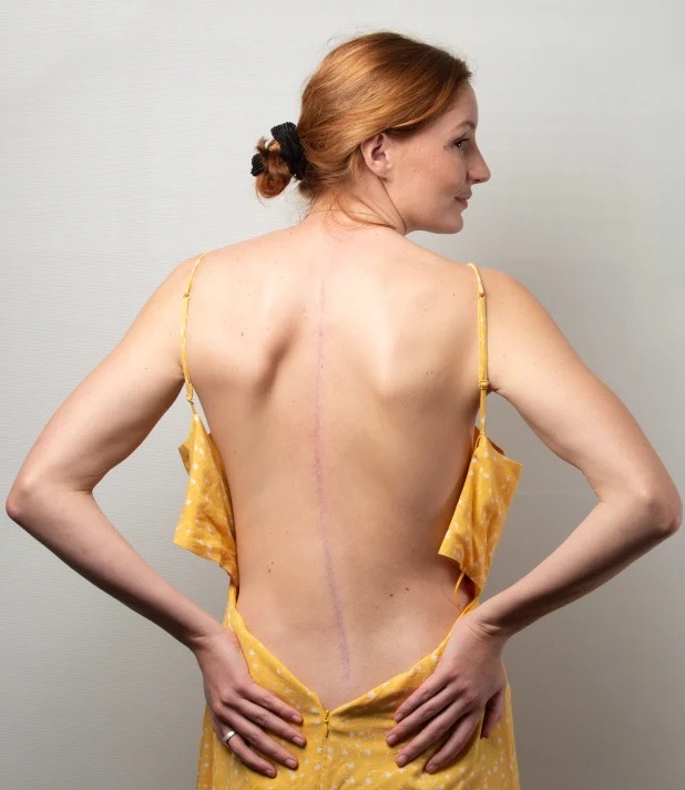 Jessica Ashwood mostra la cicatrice sulla schiena per via della sua operazione chirurgica